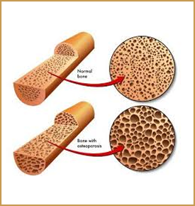Rebuilds Bone Density